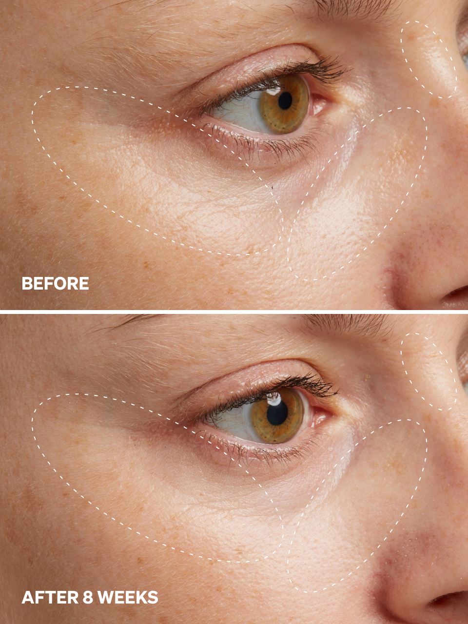 HPR Retinoid 0.3%