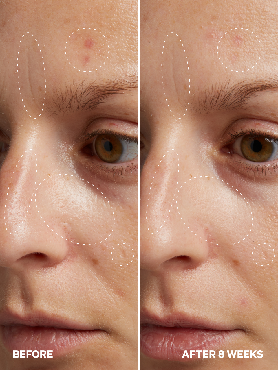 HPR Retinoid 0.3%