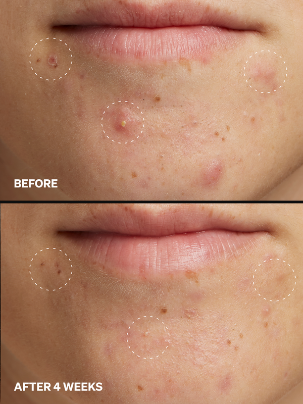 PAD Azelaic 5% - Onélogy